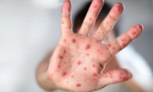 Confirman tres nuevos casos de viruela del mono en Hidalgo  &nbsp;