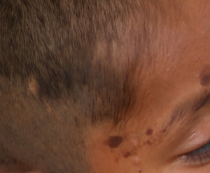 Recomienda SSH prevenir&nbsp;enfermedades dermatol&oacute;gicas&nbsp;&nbsp;&nbsp;